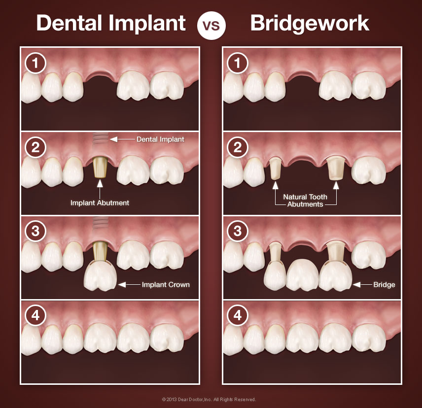 Ellenjavaslatok implant ci ra valamint k l nbs gek implant tum s